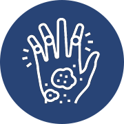 psoriatic arthritis